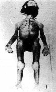 Cadavre de Holger Meins Cadavre de Holger Meins