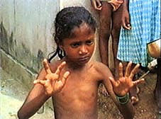 Enfant victime de malformation Enfant victime de malformation