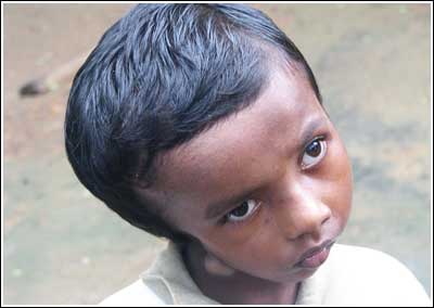 Enfant victime de malformation Enfant victime de malformation