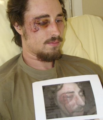 Victime d'un flash-ball