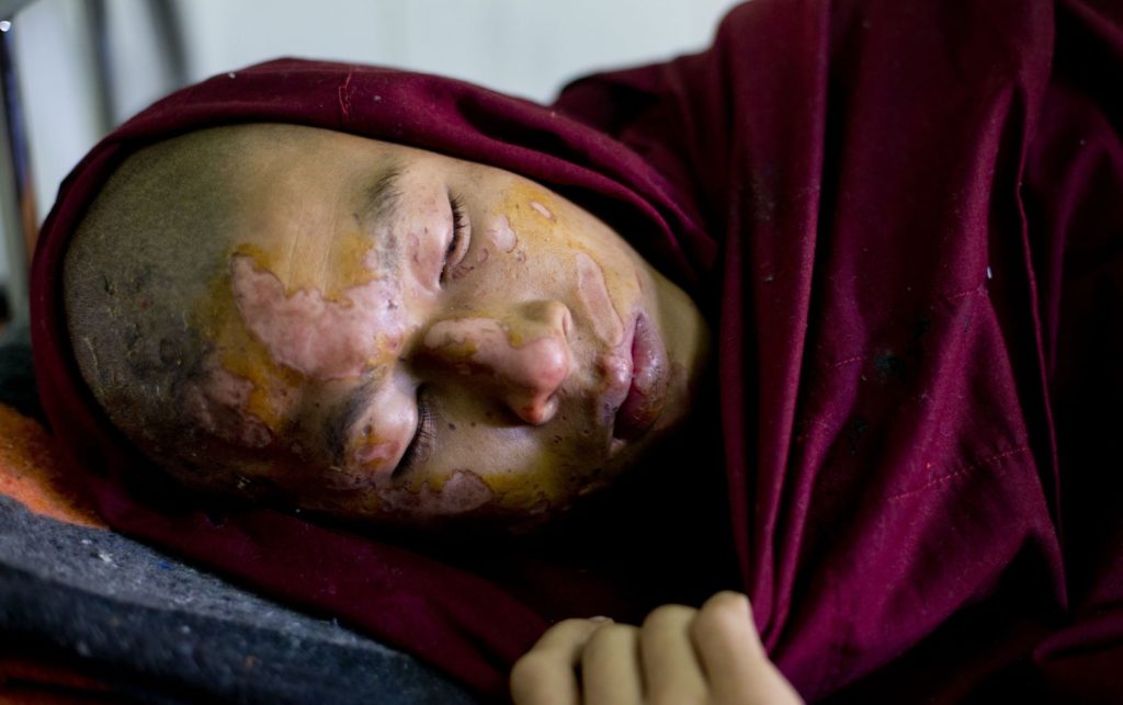 Villageois birman blessé au phosphore