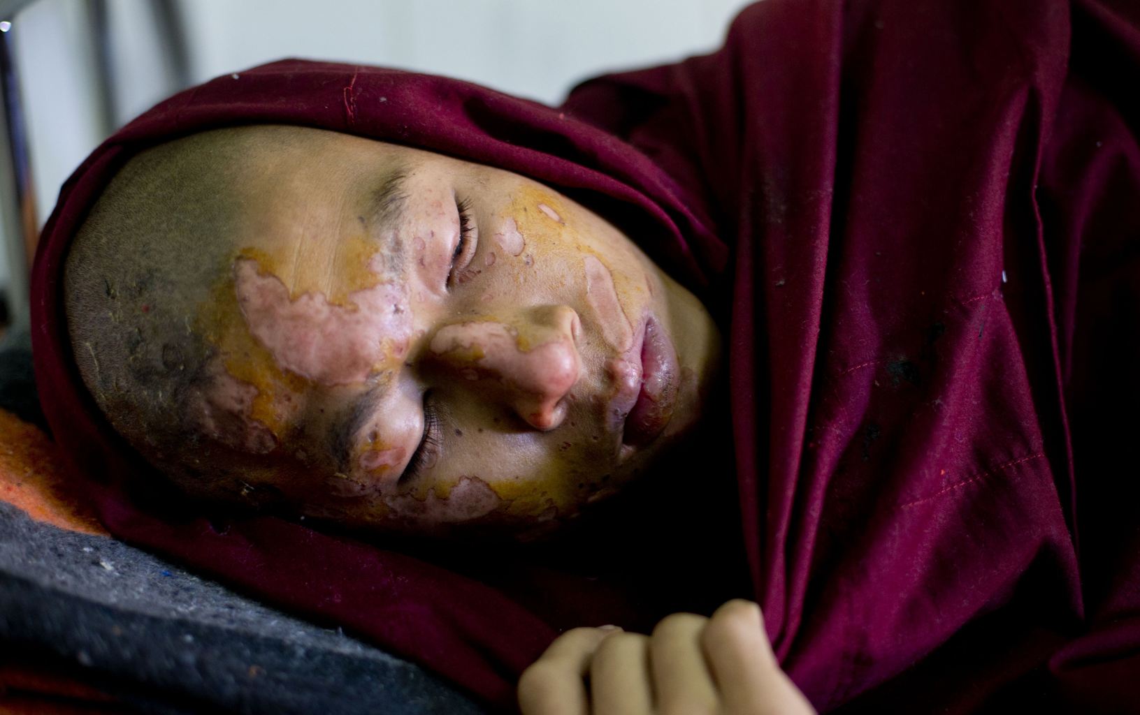 Villageois birman blessé au phosphore