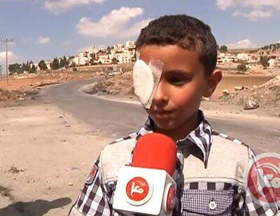 enfant palestinien éborgné