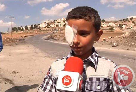 enfant palestinien éborgné