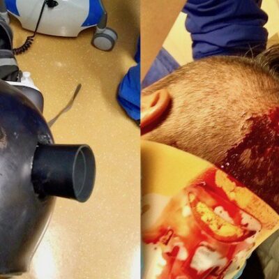 L'antifa blessé à Portland et son casque perforé par la grenade