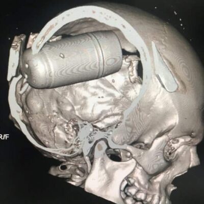 Imagerie médicale d'un patient décédé suite à l'utilisation d'une grenade brise crâne