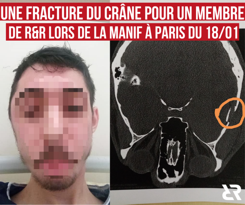 Fracture du crâne pour un militant de R&R lors de l'acte 62 des Gilets Jaunes