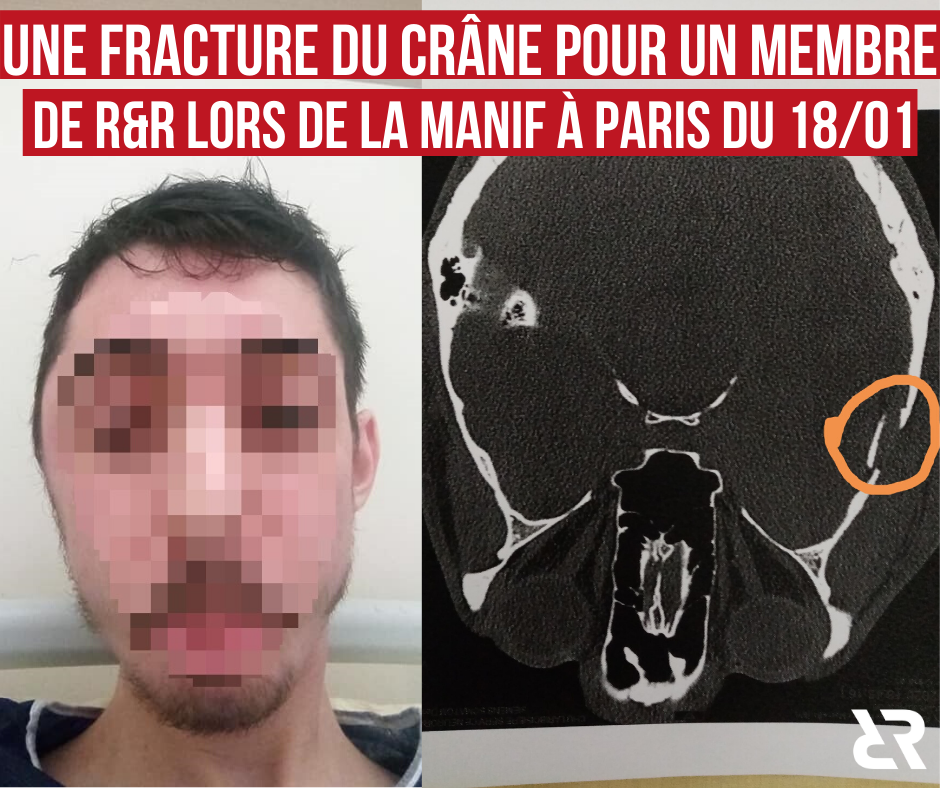Fracture du crâne pour un militant de R&R lors de l'acte 62 des Gilets Jaunes