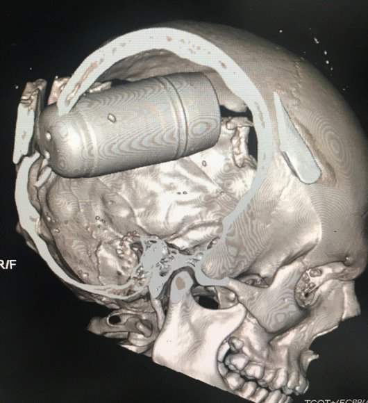 Imagerie médicale d'un patient décédé suite à l'utilisation d'une grenade brise crâne